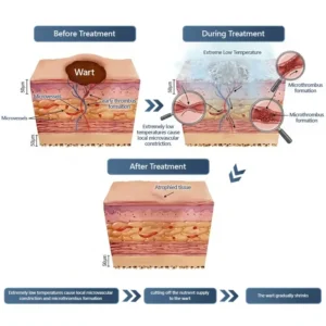 Official Store ✅|🌟 𝑽𝒊𝒕𝒂𝒍𝒊𝒔𝒚𝒔 𝑷𝒂𝒊𝒏𝒍𝒆𝒔𝒔 𝑩𝒊𝒐-𝑪𝒓𝒚𝒐𝒈𝒆𝒏 𝒕𝒆𝒄𝒉𝒏𝒐𝒍𝒐𝒈𝒚 𝑹𝒆𝒎𝒐𝒗𝒂𝒍 𝑾𝒂𝒓𝒕 𝑺𝒑𝒓𝒂𝒚| 👩‍⚕️ Instantly Remove Warts, Skin Tags & Moles – Painlessly & Safely| backed by science