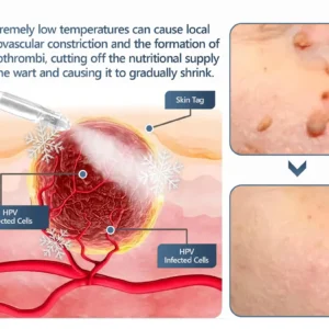 Official Store ✅|🌟 𝑽𝒊𝒕𝒂𝒍𝒊𝒔𝒚𝒔 𝑷𝒂𝒊𝒏𝒍𝒆𝒔𝒔 𝑩𝒊𝒐-𝑪𝒓𝒚𝒐𝒈𝒆𝒏 𝒕𝒆𝒄𝒉𝒏𝒐𝒍𝒐𝒈𝒚 𝑹𝒆𝒎𝒐𝒗𝒂𝒍 𝑾𝒂𝒓𝒕 𝑺𝒑𝒓𝒂𝒚| 👩‍⚕️ Instantly Remove Warts, Skin Tags & Moles – Painlessly & Safely| backed by science