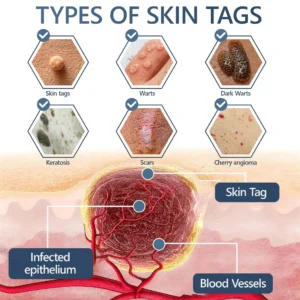 Official Store ✅|🌟 𝑽𝒊𝒕𝒂𝒍𝒊𝒔𝒚𝒔 𝑷𝒂𝒊𝒏𝒍𝒆𝒔𝒔 𝑩𝒊𝒐-𝑪𝒓𝒚𝒐𝒈𝒆𝒏 𝒕𝒆𝒄𝒉𝒏𝒐𝒍𝒐𝒈𝒚 𝑹𝒆𝒎𝒐𝒗𝒂𝒍 𝑾𝒂𝒓𝒕 𝑺𝒑𝒓𝒂𝒚| 👩‍⚕️ Instantly Remove Warts, Skin Tags & Moles – Painlessly & Safely| backed by science