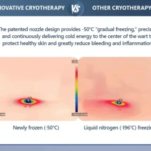 Official Store ✅|🌟 𝑽𝒊𝒕𝒂𝒍𝒊𝒔𝒚𝒔 𝑷𝒂𝒊𝒏𝒍𝒆𝒔𝒔 𝑩𝒊𝒐-𝑪𝒓𝒚𝒐𝒈𝒆𝒏 𝒕𝒆𝒄𝒉𝒏𝒐𝒍𝒐𝒈𝒚 𝑹𝒆𝒎𝒐𝒗𝒂𝒍 𝑾𝒂𝒓𝒕 𝑺𝒑𝒓𝒂𝒚| 👩‍⚕️ Instantly Remove Warts, Skin Tags & Moles – Painlessly & Safely| backed by science