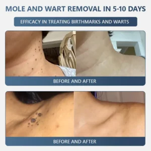 Official Store ✅|🌟 𝑽𝒊𝒕𝒂𝒍𝒊𝒔𝒚𝒔 𝑷𝒂𝒊𝒏𝒍𝒆𝒔𝒔 𝑩𝒊𝒐-𝑪𝒓𝒚𝒐𝒈𝒆𝒏 𝒕𝒆𝒄𝒉𝒏𝒐𝒍𝒐𝒈𝒚 𝑹𝒆𝒎𝒐𝒗𝒂𝒍 𝑾𝒂𝒓𝒕 𝑺𝒑𝒓𝒂𝒚| 👩‍⚕️ Instantly Remove Warts, Skin Tags & Moles – Painlessly & Safely| backed by science