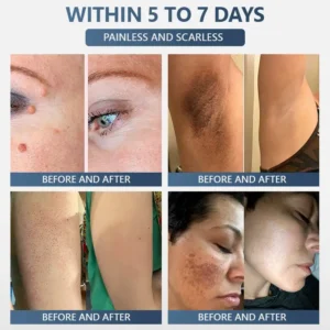 Official Store ✅|🌟 𝑽𝒊𝒕𝒂𝒍𝒊𝒔𝒚𝒔 𝑷𝒂𝒊𝒏𝒍𝒆𝒔𝒔 𝑩𝒊𝒐-𝑪𝒓𝒚𝒐𝒈𝒆𝒏 𝒕𝒆𝒄𝒉𝒏𝒐𝒍𝒐𝒈𝒚 𝑹𝒆𝒎𝒐𝒗𝒂𝒍 𝑾𝒂𝒓𝒕 𝑺𝒑𝒓𝒂𝒚| 👩‍⚕️ Instantly Remove Warts, Skin Tags & Moles – Painlessly & Safely| backed by science