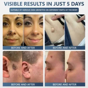 Official Store ✅|🌟 𝑽𝒊𝒕𝒂𝒍𝒊𝒔𝒚𝒔 𝑷𝒂𝒊𝒏𝒍𝒆𝒔𝒔 𝑩𝒊𝒐-𝑪𝒓𝒚𝒐𝒈𝒆𝒏 𝒕𝒆𝒄𝒉𝒏𝒐𝒍𝒐𝒈𝒚 𝑹𝒆𝒎𝒐𝒗𝒂𝒍 𝑾𝒂𝒓𝒕 𝑺𝒑𝒓𝒂𝒚| 👩‍⚕️ Instantly Remove Warts, Skin Tags & Moles – Painlessly & Safely| backed by science